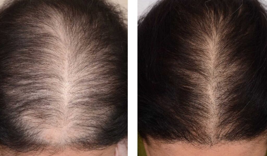 Your hair's best friend, PRP for hair loss! - Signature Aesthetica Your hair's best friend, PRP for hair loss!