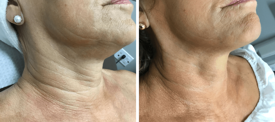 Non-surgical Skin Tightening, Best Beauty Hack