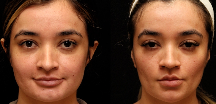 Buccal Fat Removal in Istanbul