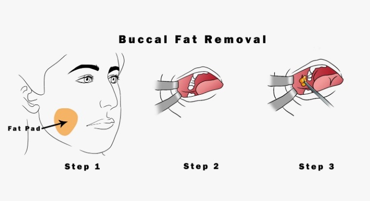 Buccal Fat Removal 