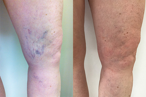 Before After Varicose veins treatment