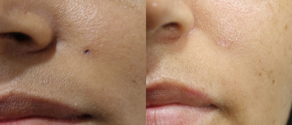 Mole Removal, We make it easy!