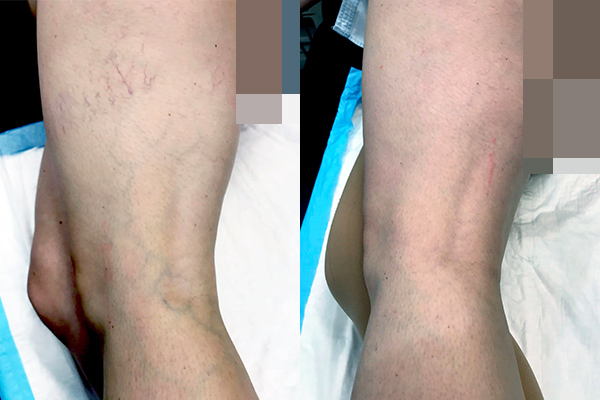 Varicose veins treatment, A sure fix for vein problems..