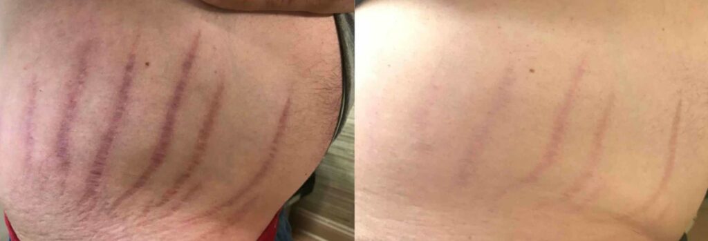 Before - After Stretch Marks Removal in Istanbul