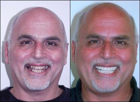 Dental Implants for a lifetime of smiles!