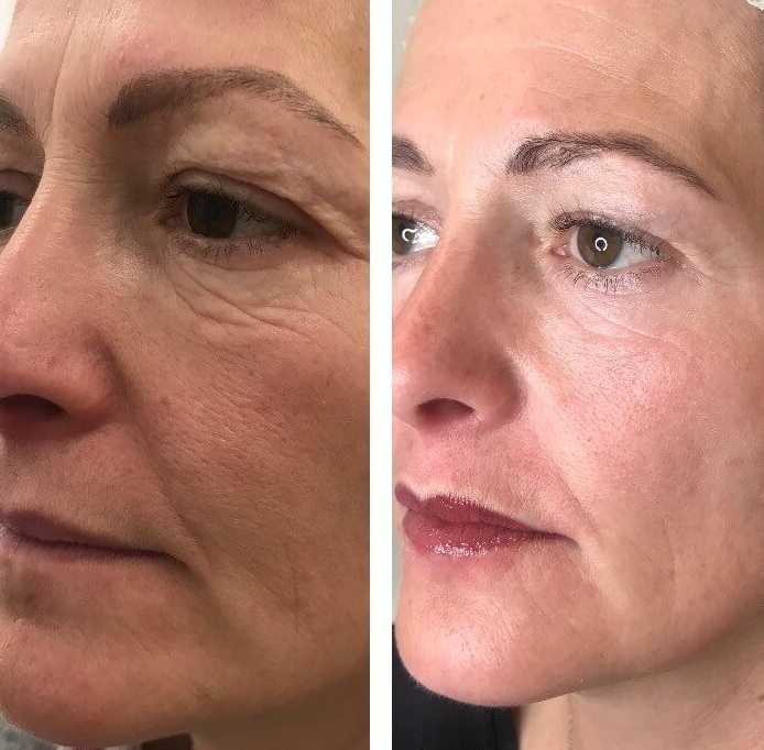 Non-Surgical Facelift