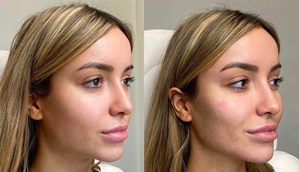 Dermal Filler, Plump it up, perfect it out!