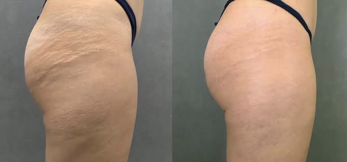 Stretch Marks Removal, Uncover the Beautiful You!