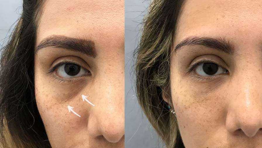 Dermal Filler, Plump it up, perfect it out!