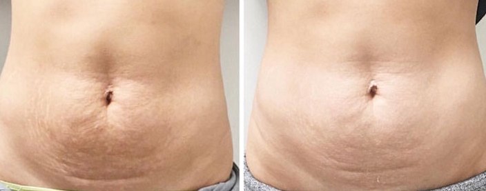 Stretch Marks Removal, Uncover the Beautiful You!