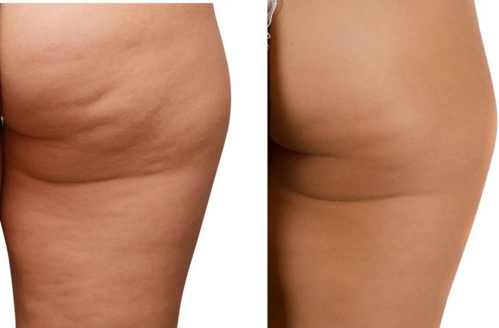 Energize with best Cellulite treatment