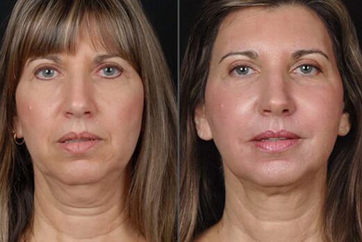 Non-Surgical Facelift, No Knife, All Stunning