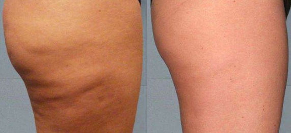 Energize with best Cellulite treatment