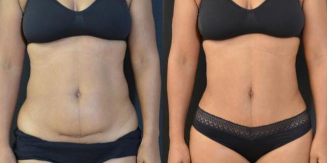 Body Lift 360° before after