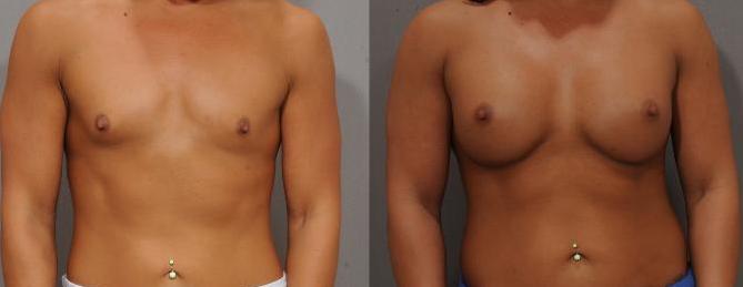 Breast Augmentation Surgery in Istanbul