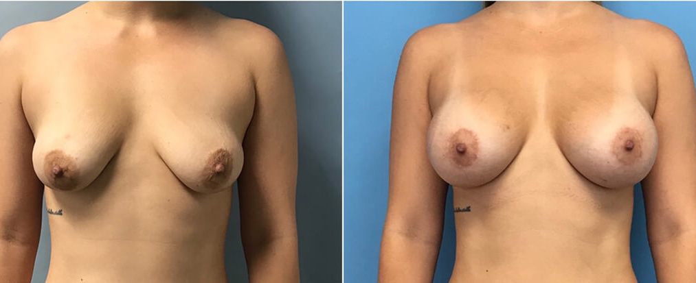 Breast Augmentation, Natural Look, Stunning Results!