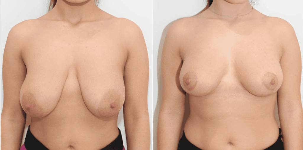 Breast Reduction, Feel Light, Look Right!