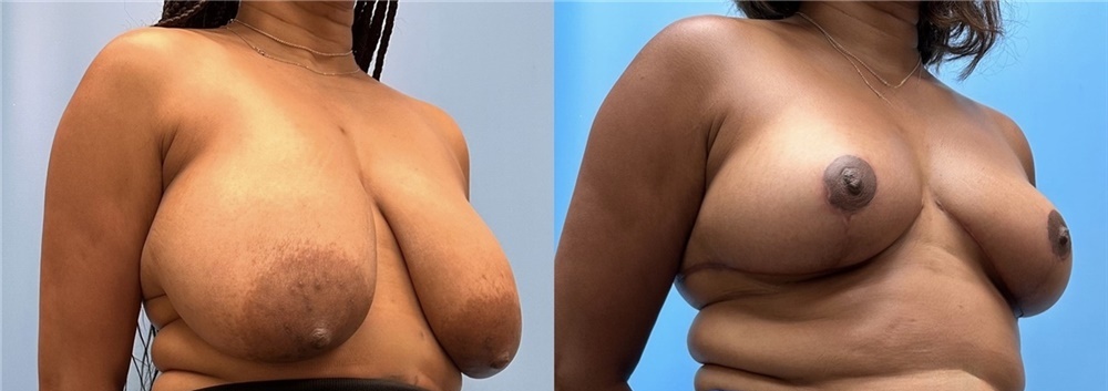 Breast Reduction before after