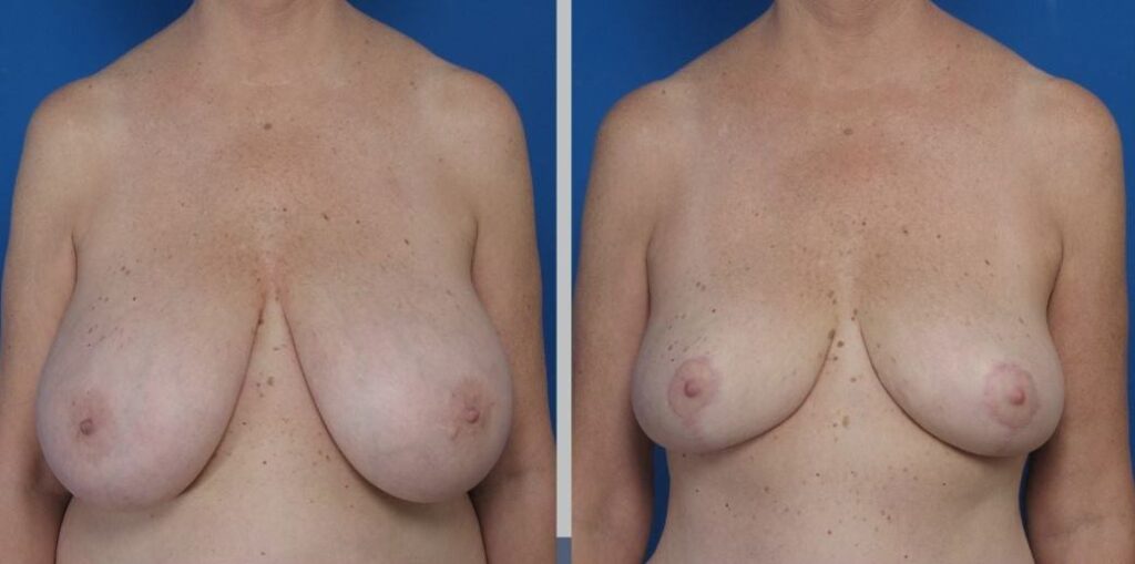 Breast Reduction, Feel Light, Look Right!