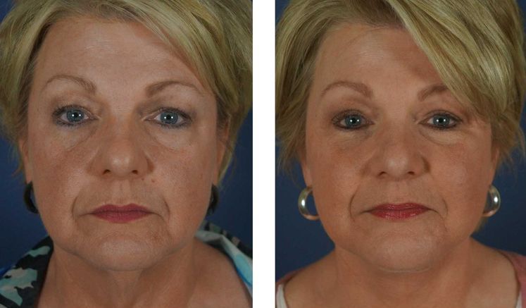 Fat Transfer.. Sculpt, Restore, Rejuvenate!