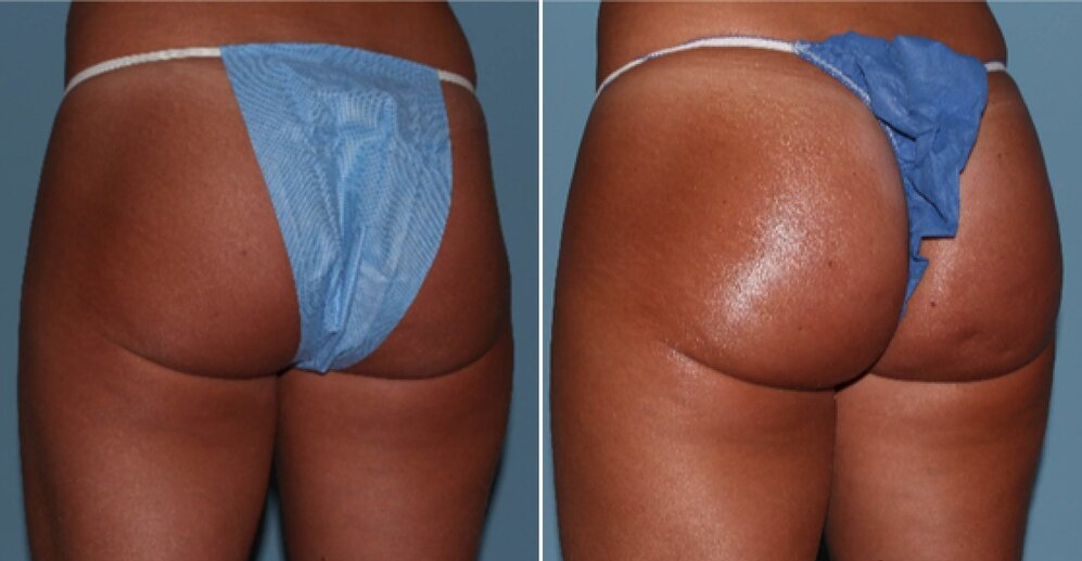 Fat Transfer.. Sculpt, Restore, Rejuvenate!