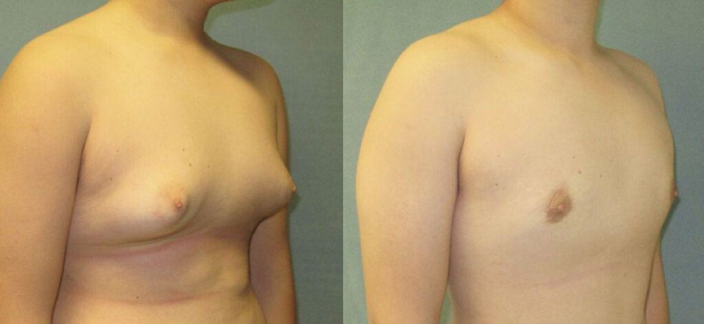 Gynecomastia, No More Oversized Shirts!