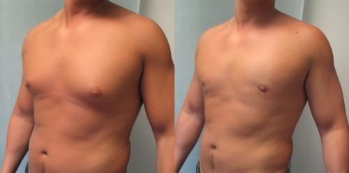 Gynecomastia Surgery before after