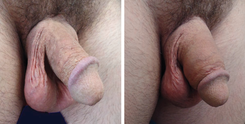 Before After Penis Enlargement Surgery