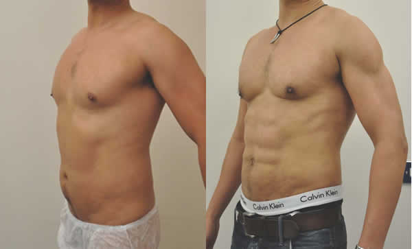 Six Pack Abs Surgery, Sculpted to Perfection!