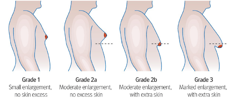 Gynecomastia Levels 