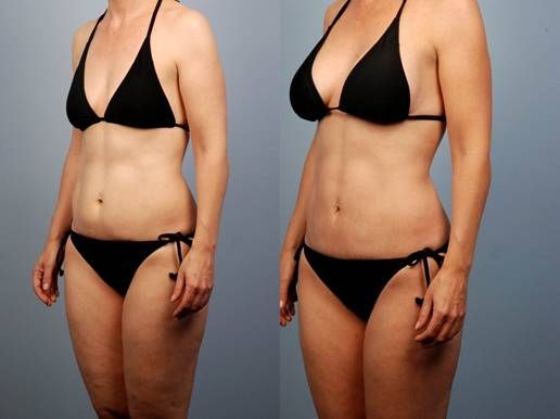 Mommy Makeover, Love Your Body Again!