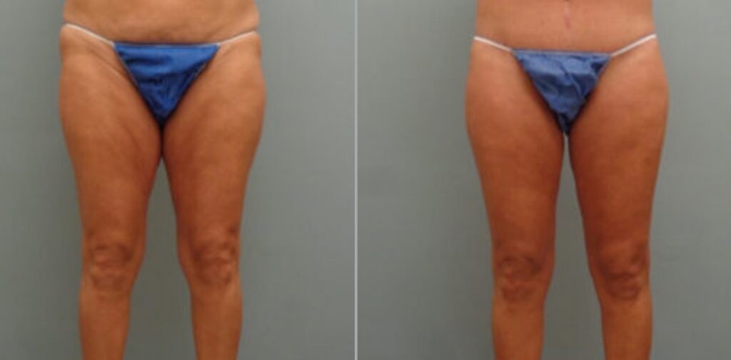 Thigh Lift, Redefine Your Curves - Signature Aesthetica Thigh Lift, Redefine Your Curves