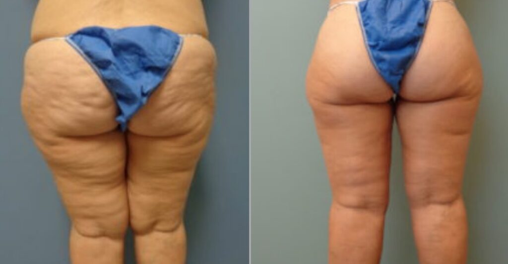 Thigh Lift, Redefine Your Curves - Signature Aesthetica Before After Thigh Lift