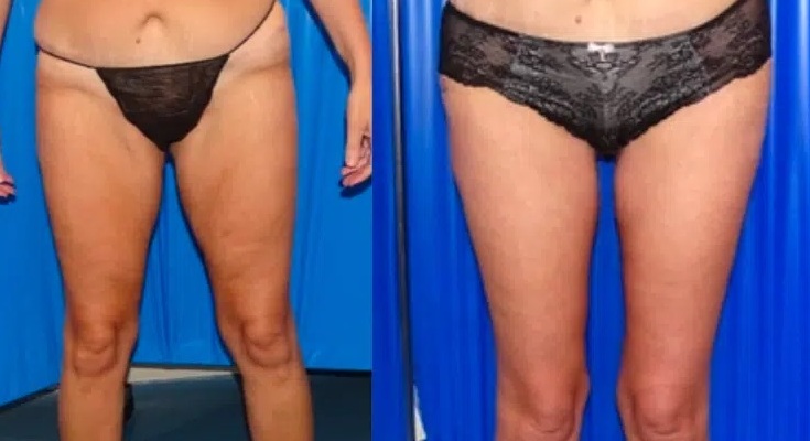 Thigh Lift, Redefine Your Curves - Signature Aesthetica Thigh Lift, Redefine Your Curves