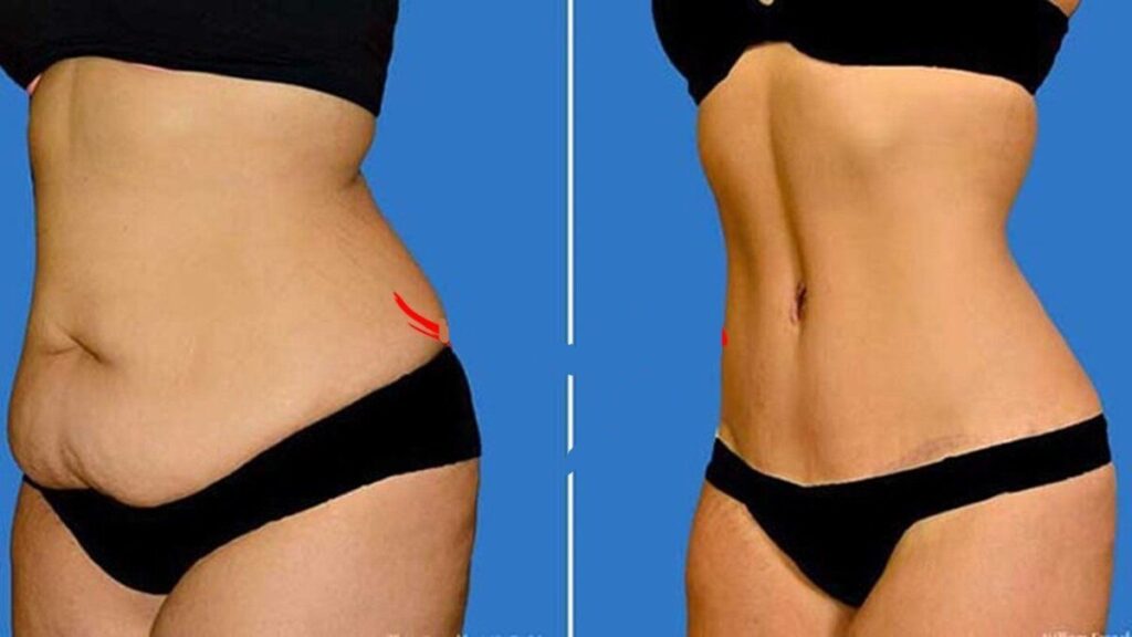 Tummy Tuck, You Deserve to Feel Amazing!