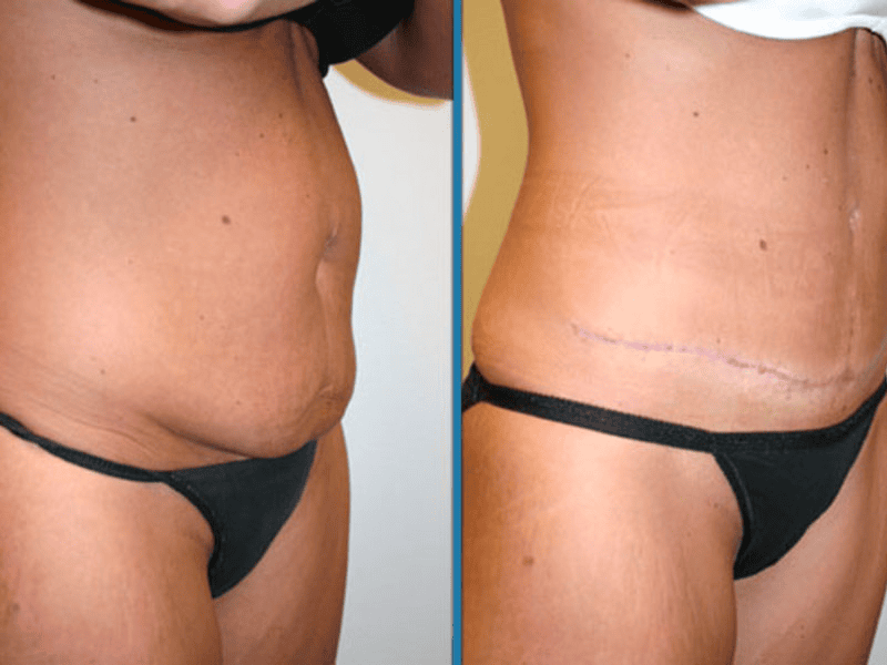 Tummy Tuck, You Deserve to Feel Amazing!