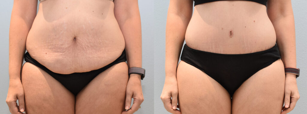 Tummy Tuck, You Deserve to Feel Amazing!