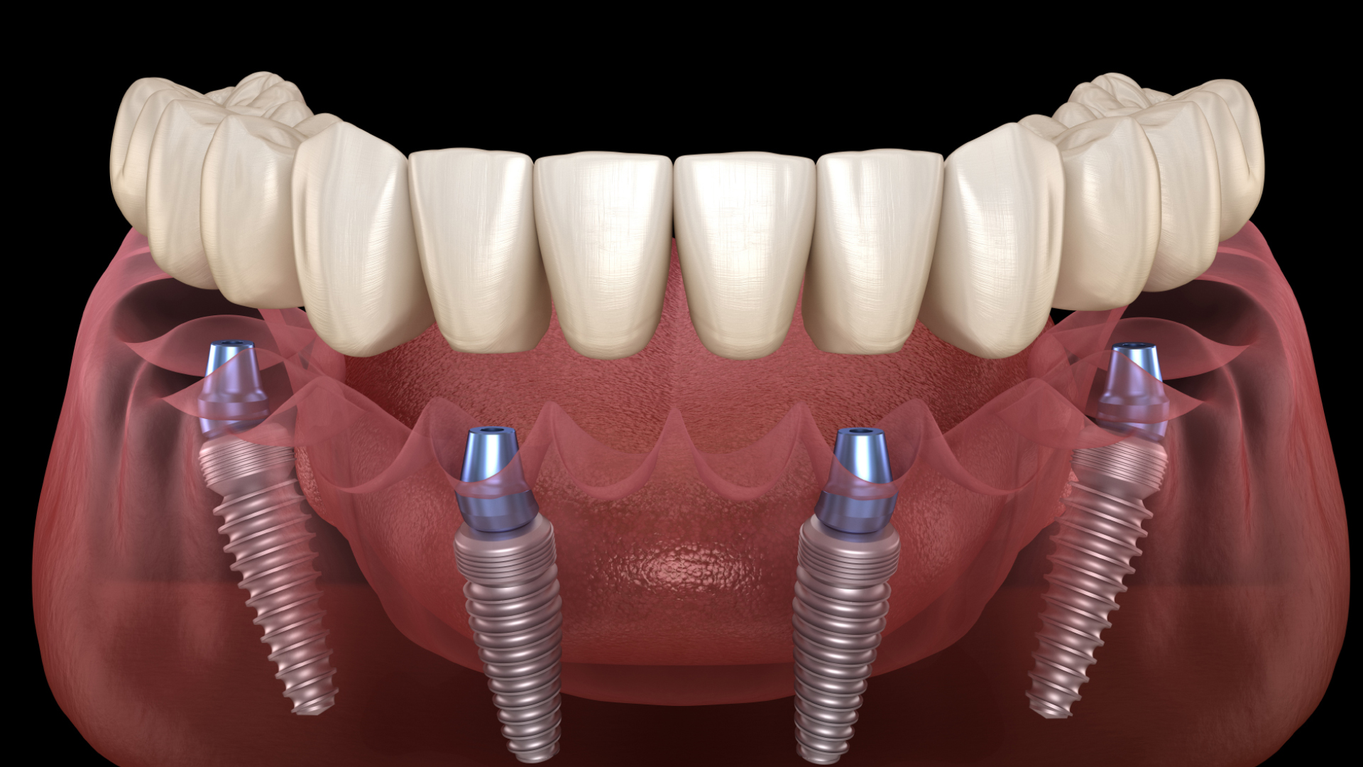 All on Four Dental Implants in Istanbul