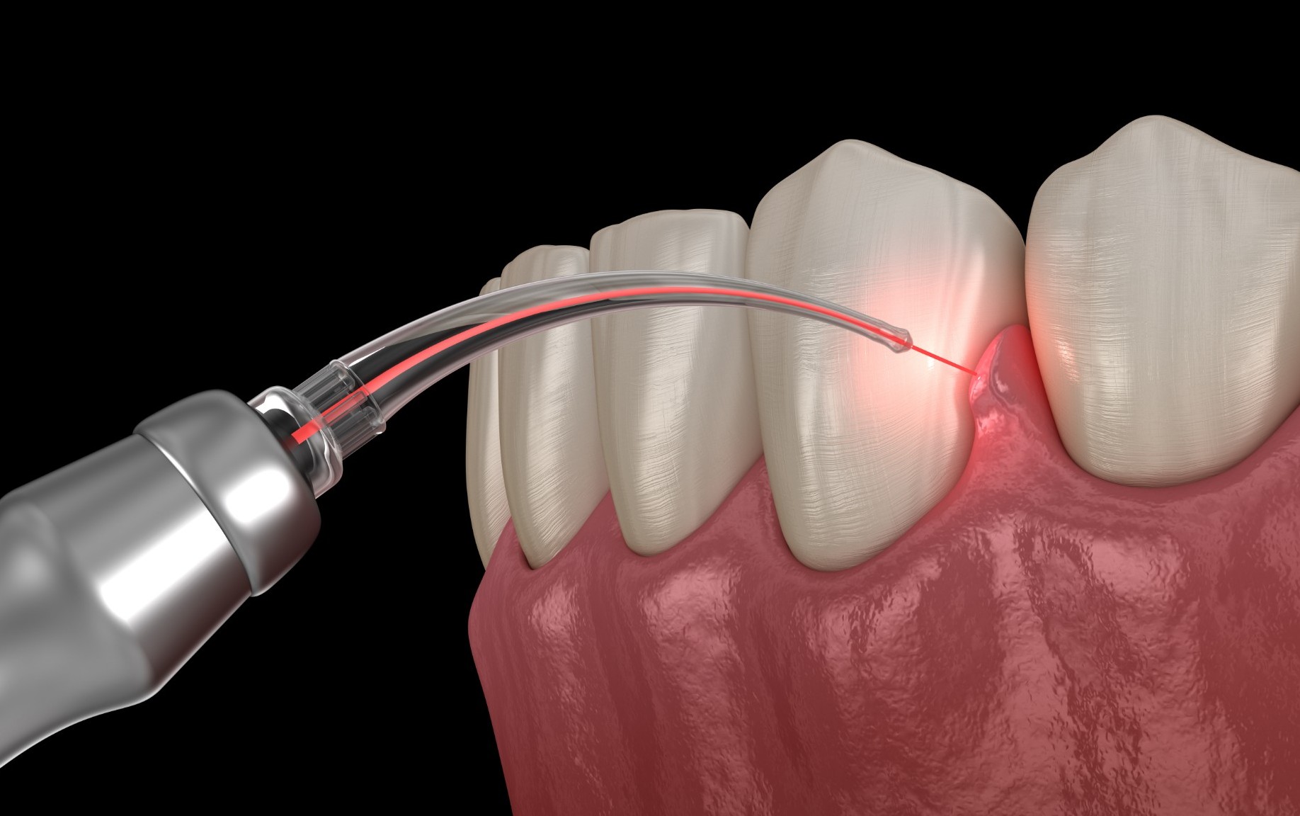 Gum Treatment in Istanbul