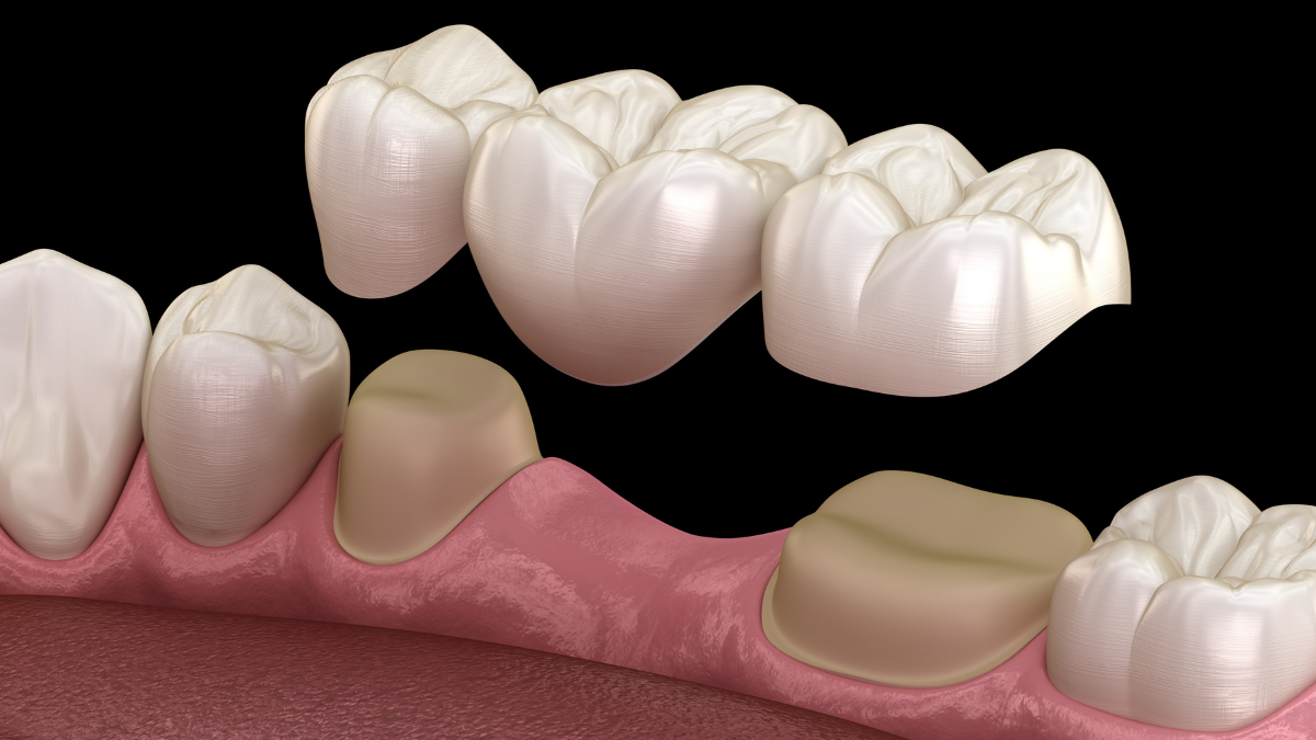 Teeth Restoration in istanbul